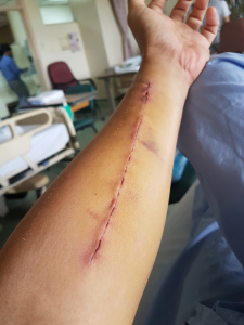 Scars left after docs took veins from arm to do grafts