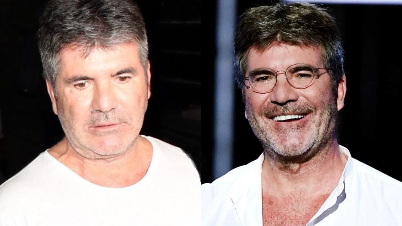 simon-cowell-removes-face-fillers-saying-it’s-too-much