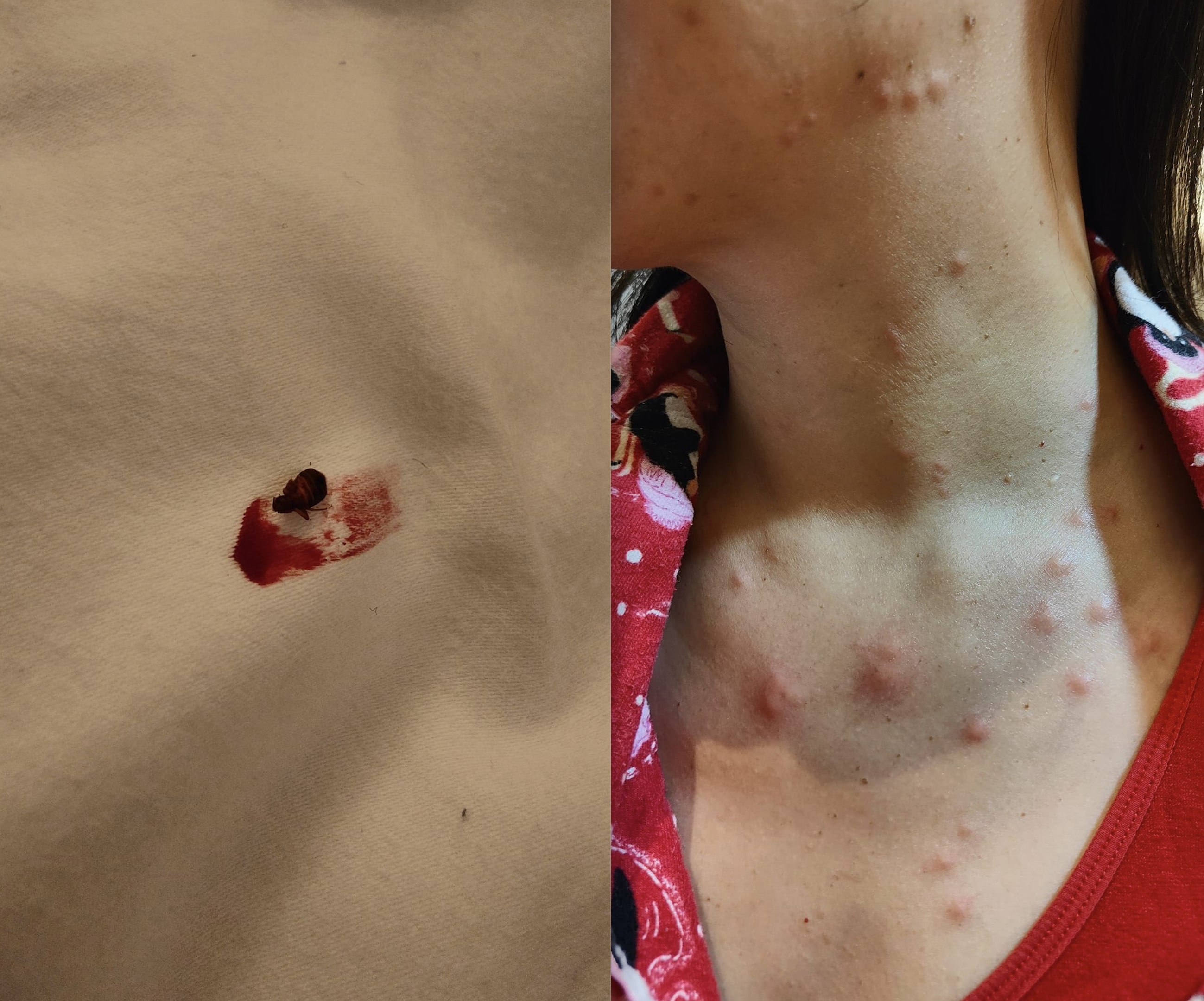 Staycationers traumatised after getting bitten by bed bugs, asked how Jalan Besar hotel got SG Clean Certified