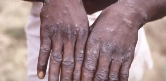 monkeypox